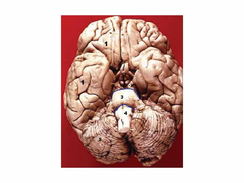 The three divisions of the brainstem are seen here in this anterior- inferior view. - - 1. Cerebrum - 2. Mesencephalon - Midbrain - 3. Pons - 4. Medulla oblongata - 5. Cerebellum
